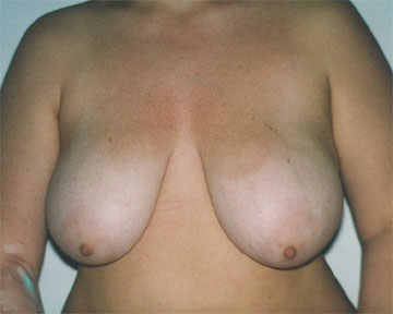 Breast Reduction (for Women) before and after photo