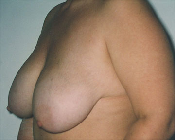 Breast Reduction (for Women) before and after photo