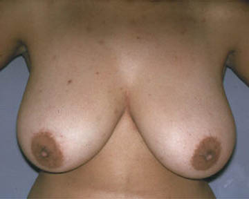 Breast Reduction (for Women) before and after photo