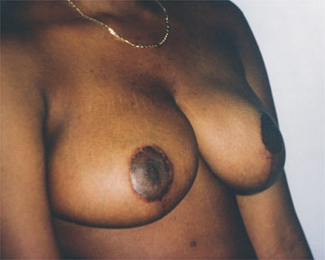 Breast Reduction (for Women) before and after photo