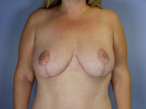 Breast Reduction (for Women) before and after photo