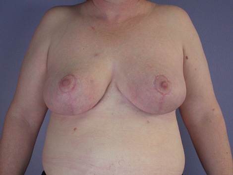 Breast Reduction (for Women) before and after photo