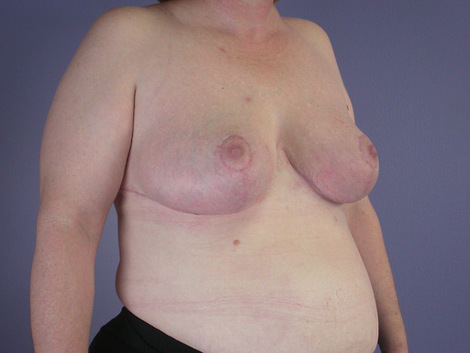 Breast Reduction (for Women) before and after photo