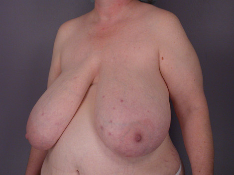 Breast Reduction (for Women) before and after photo