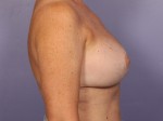 Breast Reduction (for Women) Before and after photo