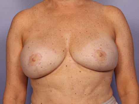 Breast Reduction (for Women) before and after photo