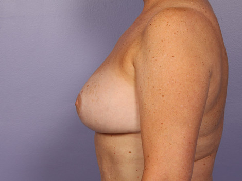 Breast Reduction (for Women) before and after photo