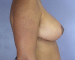 Breast Reduction (for Women) Before and after photo