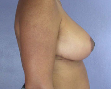 Breast Reduction (for Women) before and after photo