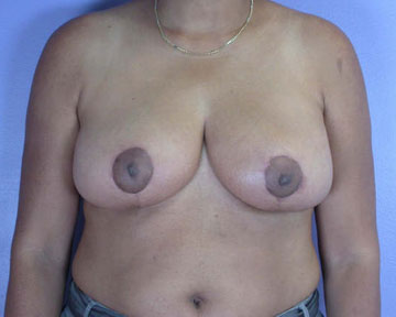 Breast Reduction (for Women) before and after photo