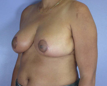 Breast Reduction (for Women) before and after photo