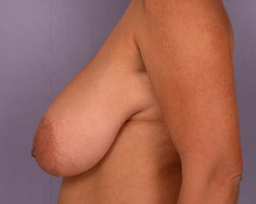 Breast Reduction (for Women) before and after photo