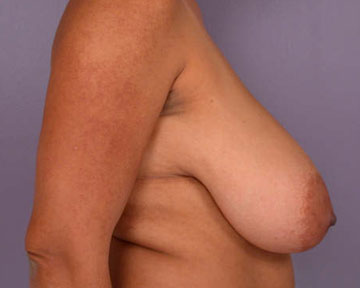 Breast Reduction (for Women) before and after photo