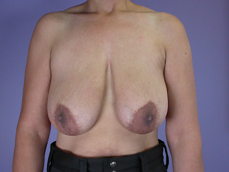 Breast Reduction (for Women) before and after photo