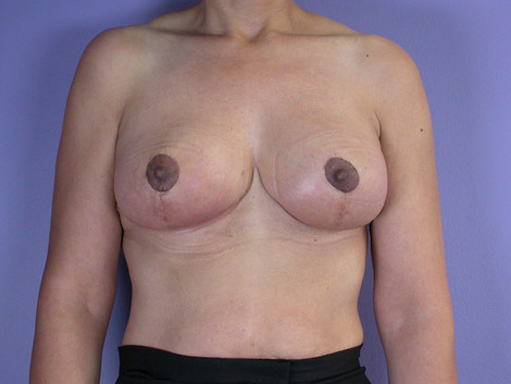 Breast Reduction (for Women) before and after photo