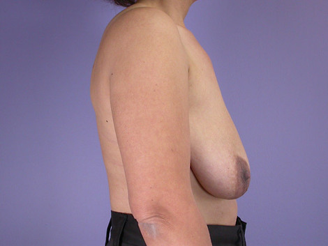 Breast Reduction (for Women) before and after photo