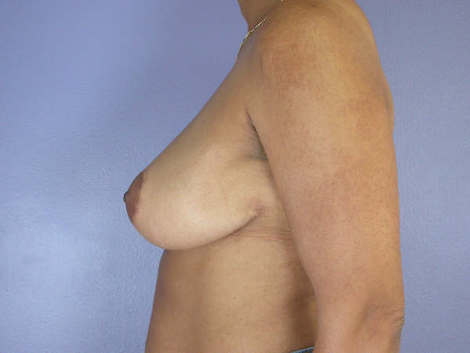 Breast Reduction (for Women) before and after photo