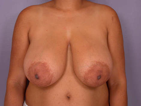 Breast Reduction (for Women) before and after photo