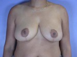 Breast Reduction (for Women)