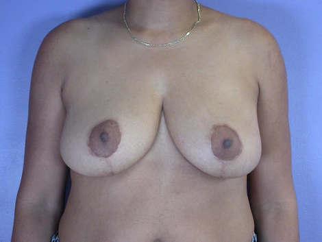 Breast Reduction (for Women) before and after photo