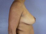 Breast Reduction (for Women) Before and after photo