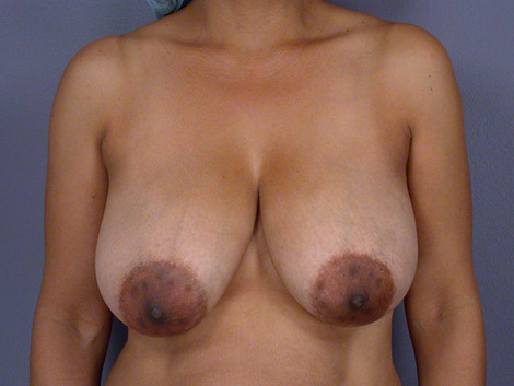 Breast Reduction (for Women) before and after photo