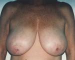 Breast Reduction (for Women)