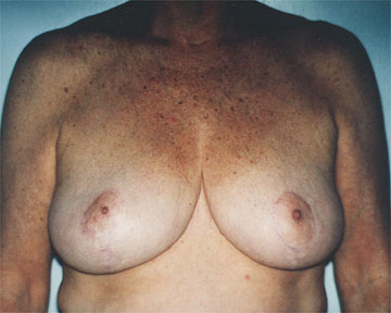 Breast Reduction (for Women) before and after photo