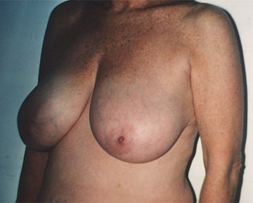 Breast Reduction (for Women) before and after photo