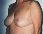 Breast Reduction (for Women)