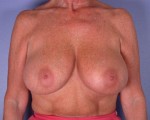 Breast Reduction (for Women) Before and after photo