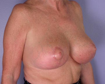 Breast Reduction (for Women) before and after photo