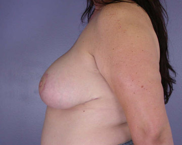 Breast Reduction (for Women) before and after photo