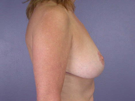 Breast Reduction (for Women) before and after photo