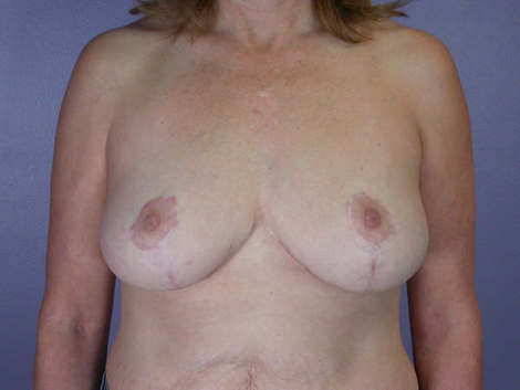 Breast Reduction (for Women) before and after photo