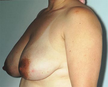 Breast Reduction (for Women) before and after photo