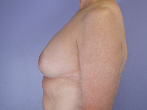 Breast Reduction (for Women) before and after photo