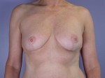 Breast Reduction (for Women)