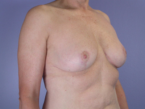 Breast Reduction (for Women) before and after photo