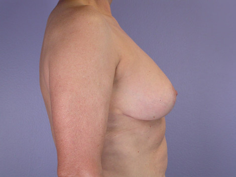 Breast Reduction (for Women) before and after photo