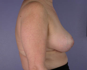 Breast Reduction (for Women) before and after photo