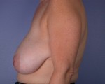 Breast Reduction (for Women)