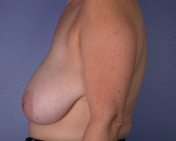 Breast Reduction (for Women) before and after photo