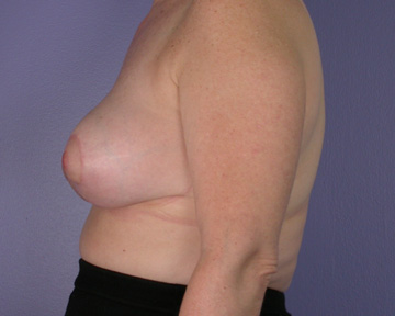 Breast Reduction (for Women) before and after photo