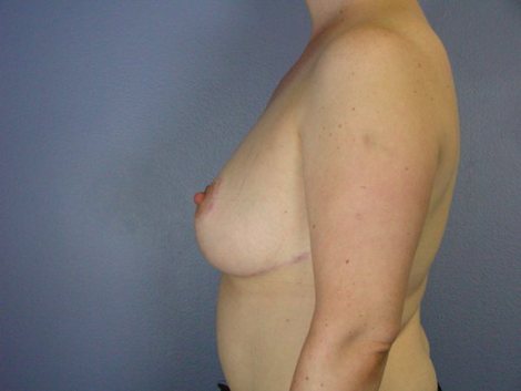 Breast Reduction (for Women) before and after photo