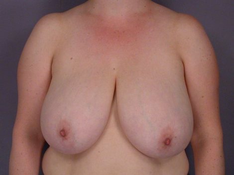 Breast Reduction (for Women) before and after photo