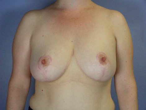 Breast Reduction (for Women) before and after photo