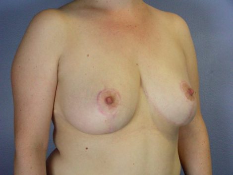 Breast Reduction (for Women) before and after photo