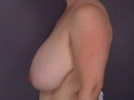 Breast Reduction (for Women) Before and after photo