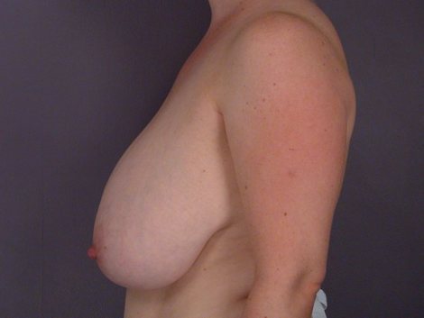 Breast Reduction (for Women) before and after photo